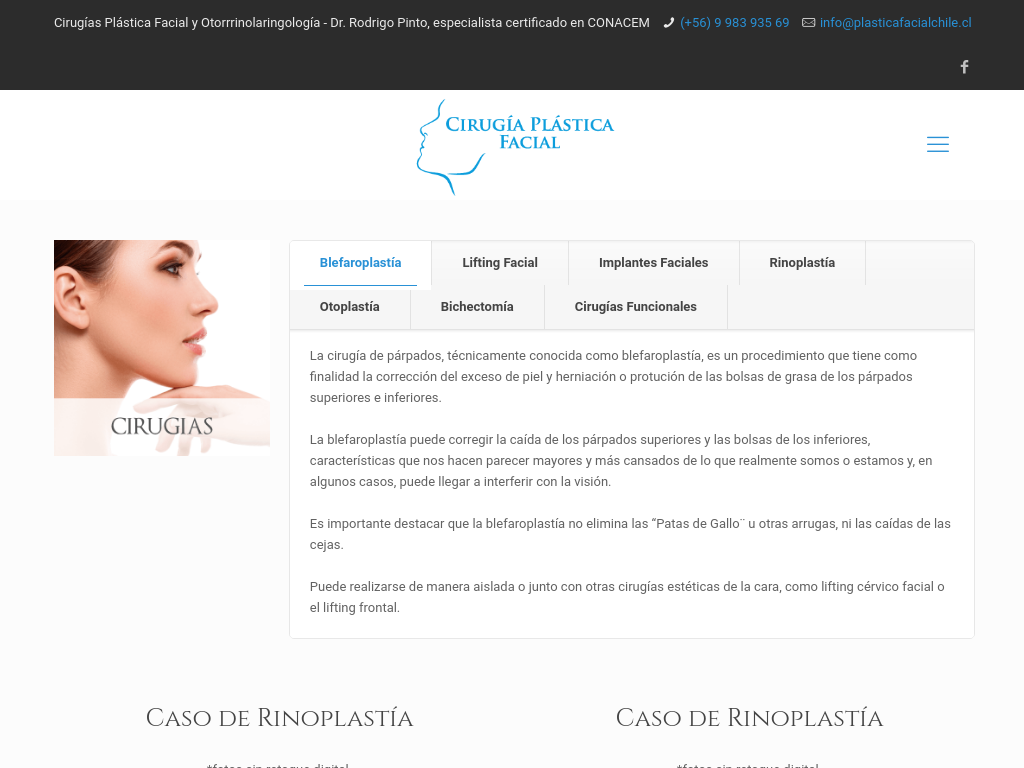 Lifting facial en Santiago